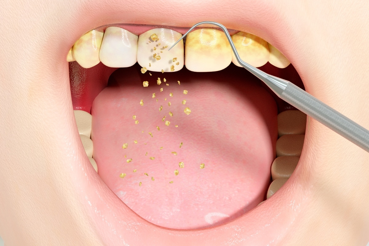 How to Remove Permanent Yellow Stains From Teeth?