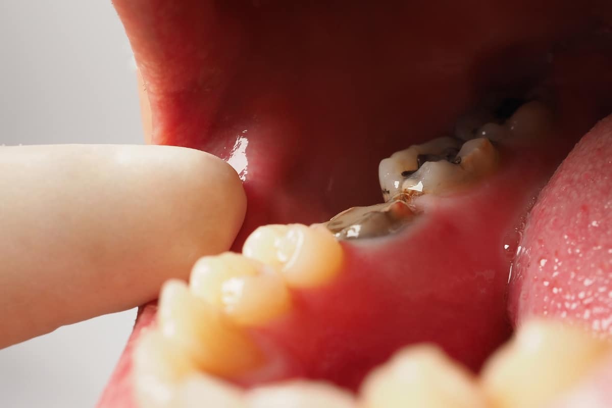 What Should You Do If Your Wisdom Tooth Has a Cavity?