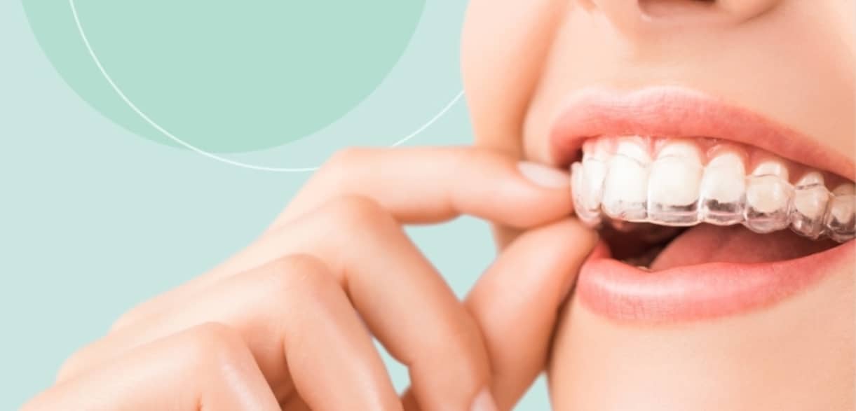 What Should You Expect In Your First Month With Clear Aligners?
