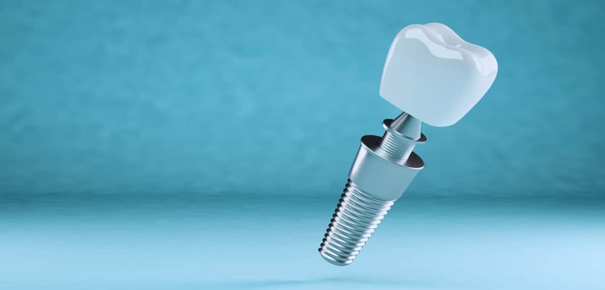 What Maintenance Is Required For Dental Implants?