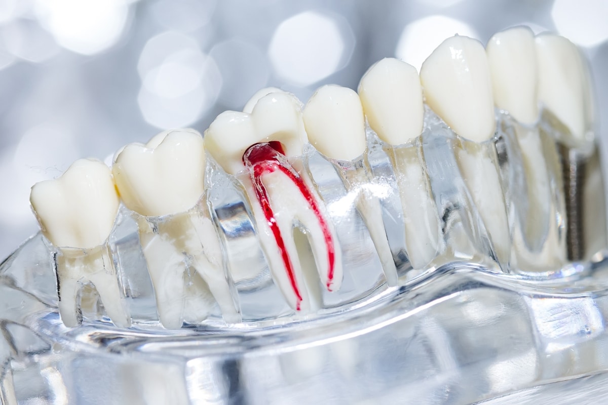 How to Protect Your Tooth After a Root Canal: Tips for a Healthy Smile